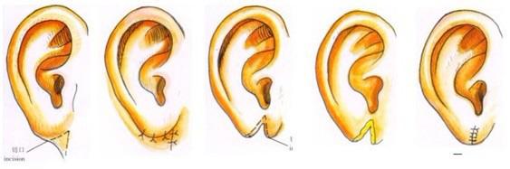 全耳畸形矫正对听力有帮助吗