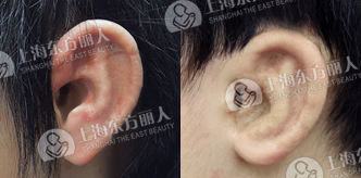 耳廓整形修复需要多少钱