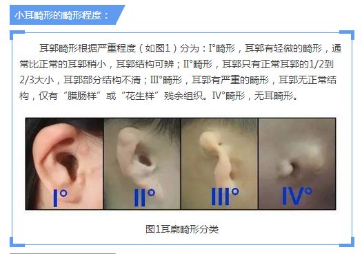 小耳畸形程度分型3度