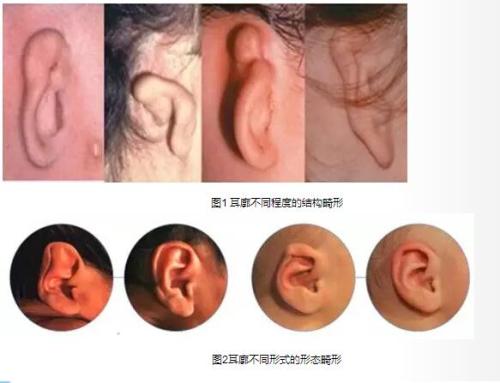 这几类耳廓畸你知多少