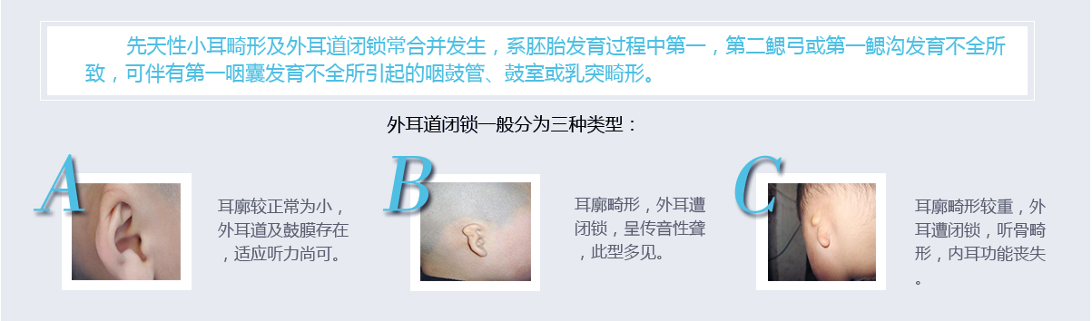 耳道口成型矫正