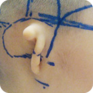 先天性外耳道闭锁的Ⅱ型
