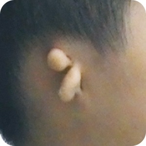 Ⅲ度小耳畸形