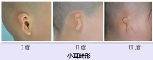 三度小耳畸形