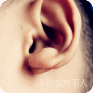 耳廓畸形