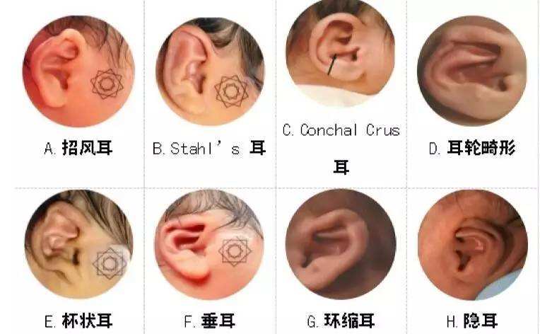 八种常见耳廓畸形