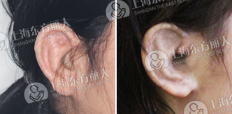 外耳道成形术手术